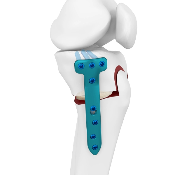 แผ่นล็อค Osteotomy Proximal Medial Tibial
