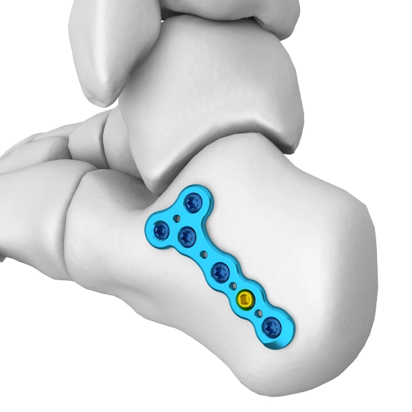 แผ่นล็อค Calcaneal Tuberosity หลัง MT